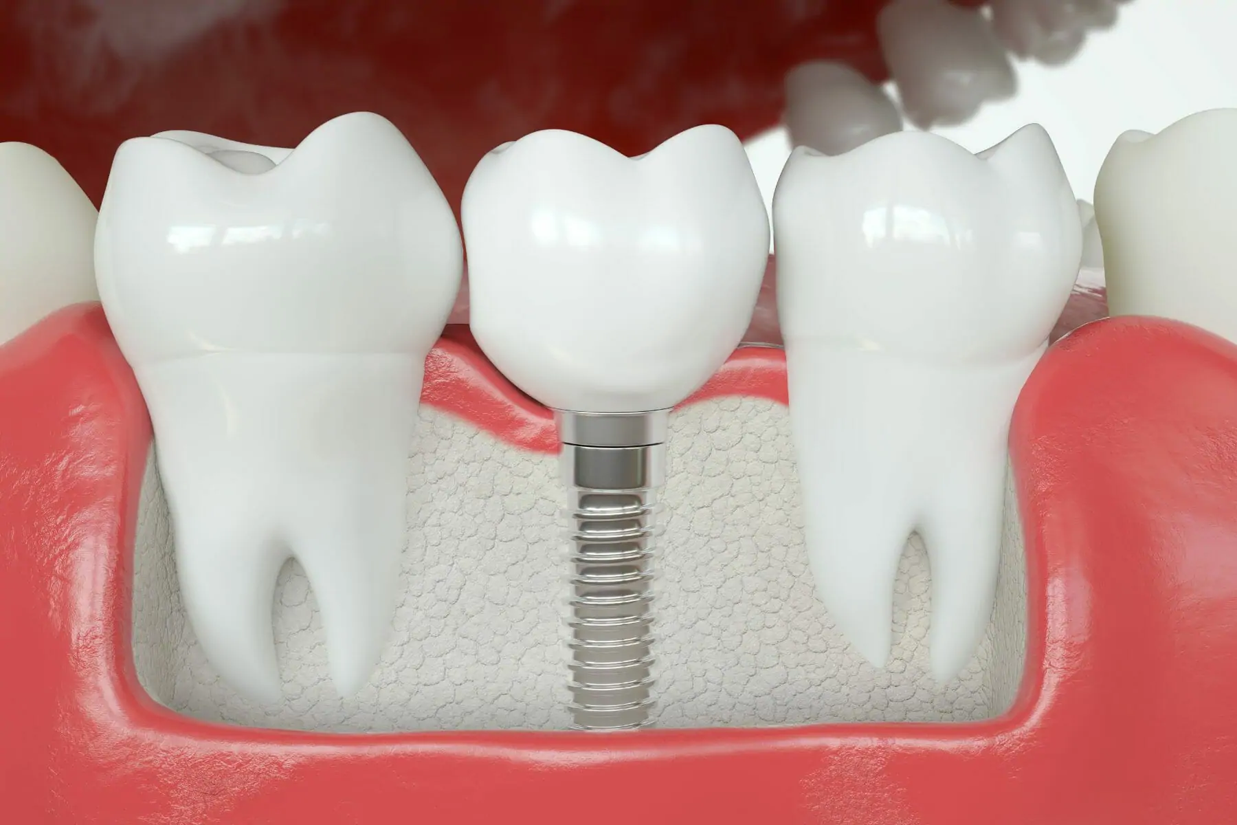 TeethSavers Dental-Crown-vs-Dental-Implant