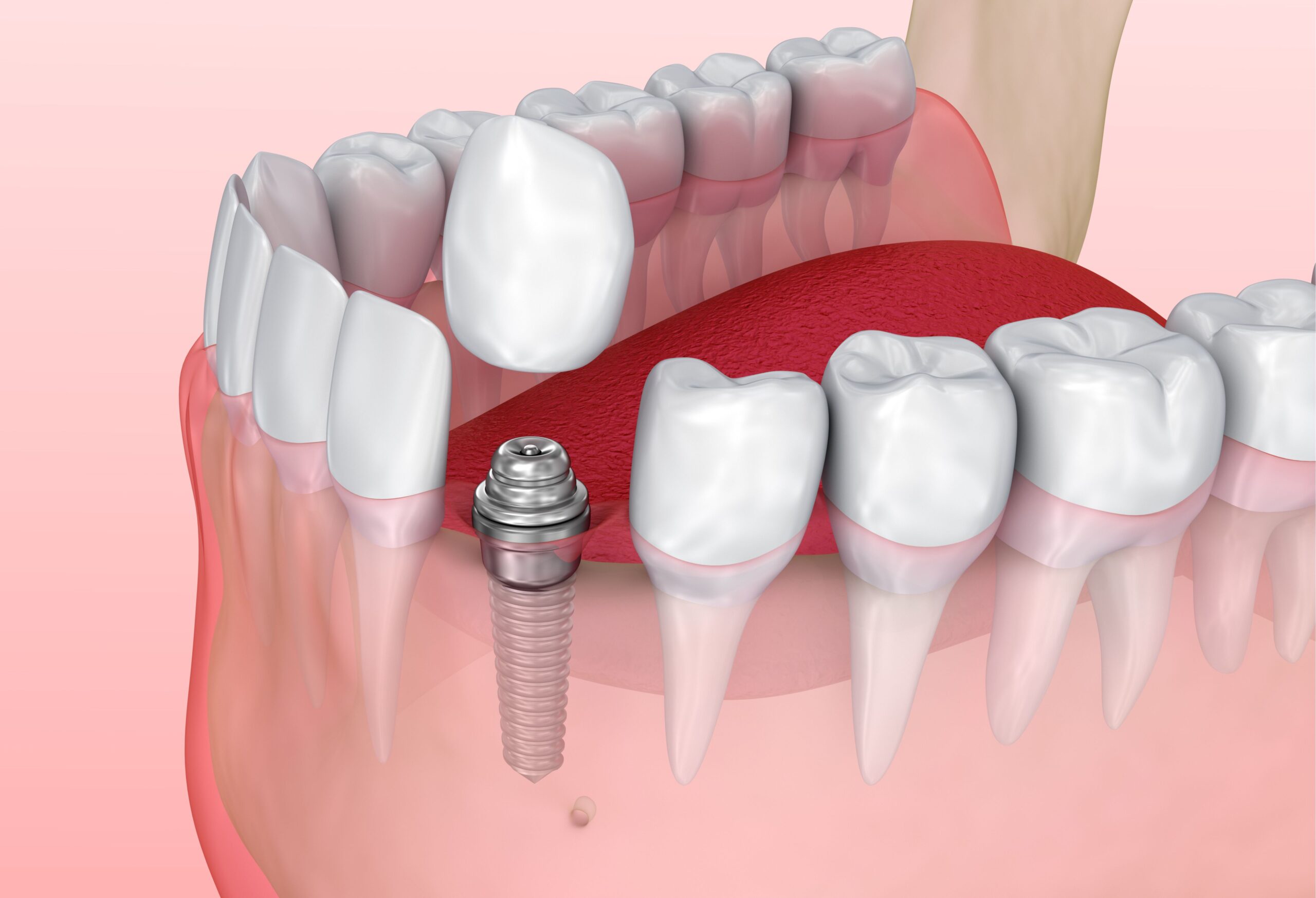 TeethSavers Dental implant with crown