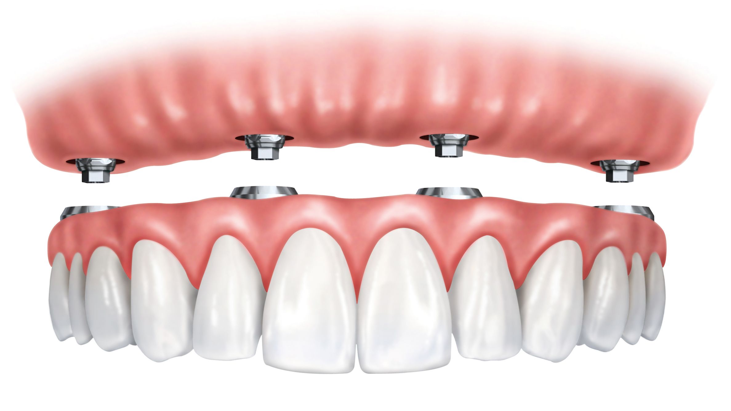 TeethSavers Full Arch Implant Rehabilitation per Arch
