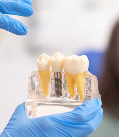 Experienced dentists providing full mouth dental implants in Mexico at Teeth 