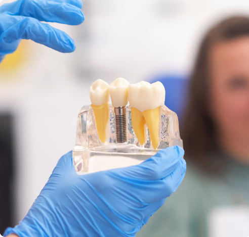 Dentists showing model dental implant process